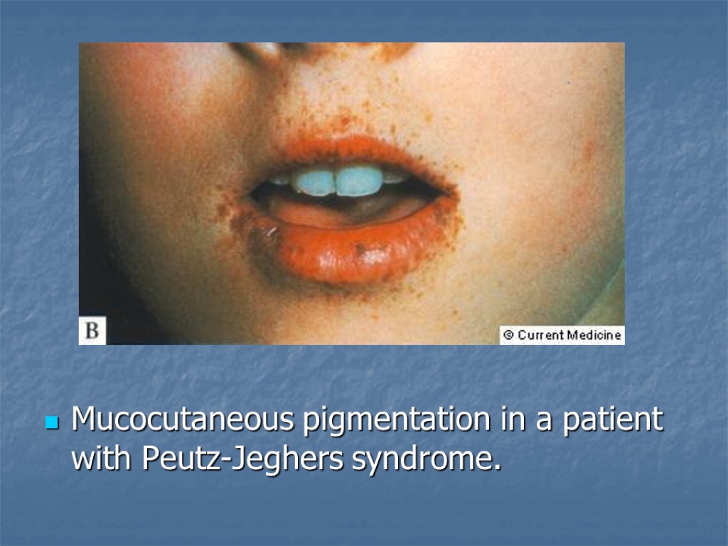 Mucocutaneous pigmentation in a patient with Peutz-Jeghers syndrome.